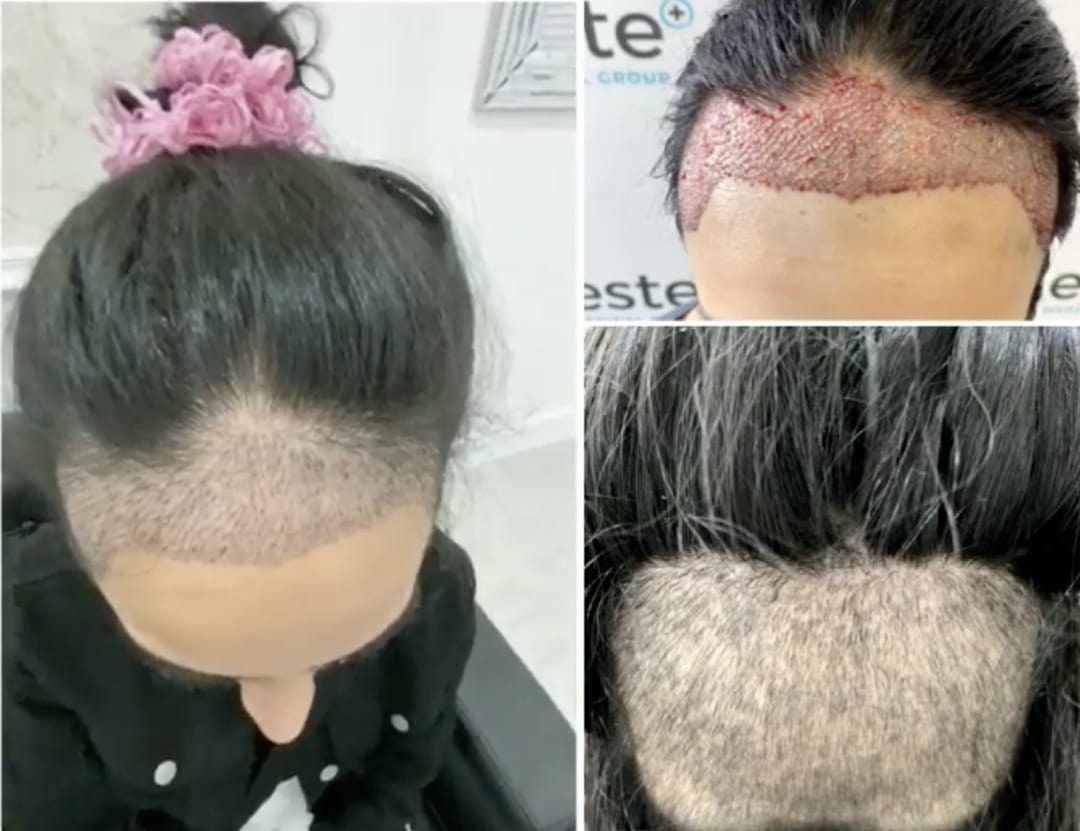 Hair Transplant Birmingham FUE Hair Transplant Before and After